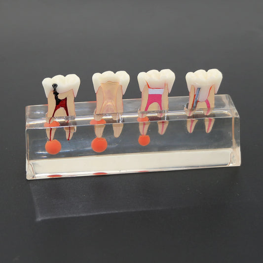 Dantų modelis, 4 stadijų endodontinis gydymas, aiškiai demonstruojantis modelis studijoms, mokymui, klinikos dekoravimui