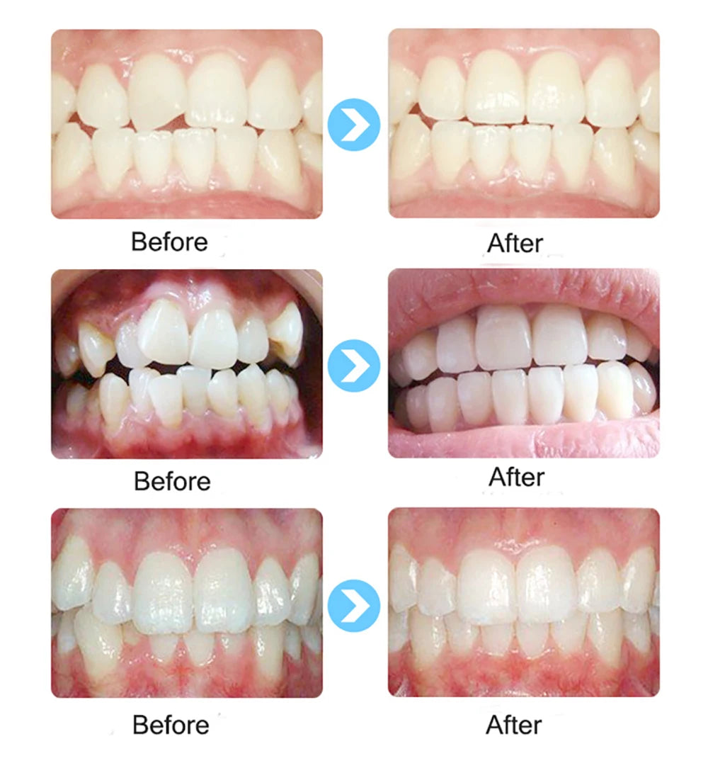 1 set Dental T4A&T4K Tooth Orthodontic Appliance Trainer for Alignment Braces Teeth Trainer for Adults Children Tooth Whitening
