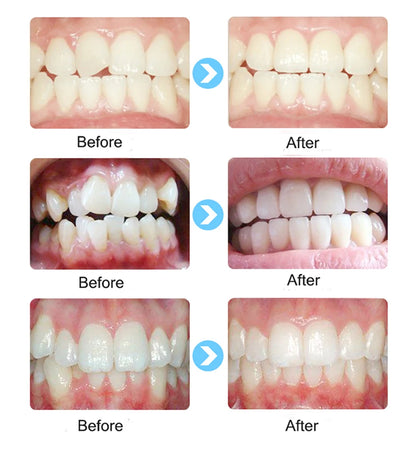 1 set Dental T4A&T4K Tooth Orthodontic Appliance Trainer for Alignment Braces Teeth Trainer for Adults Children Tooth Whitening