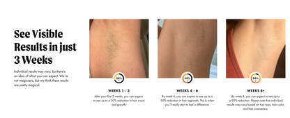Laser Hair Removal with Ice Cooling Care Function for Women Men Permanent,Unlimited Flashes Painless Epilator IPL Hair Remover