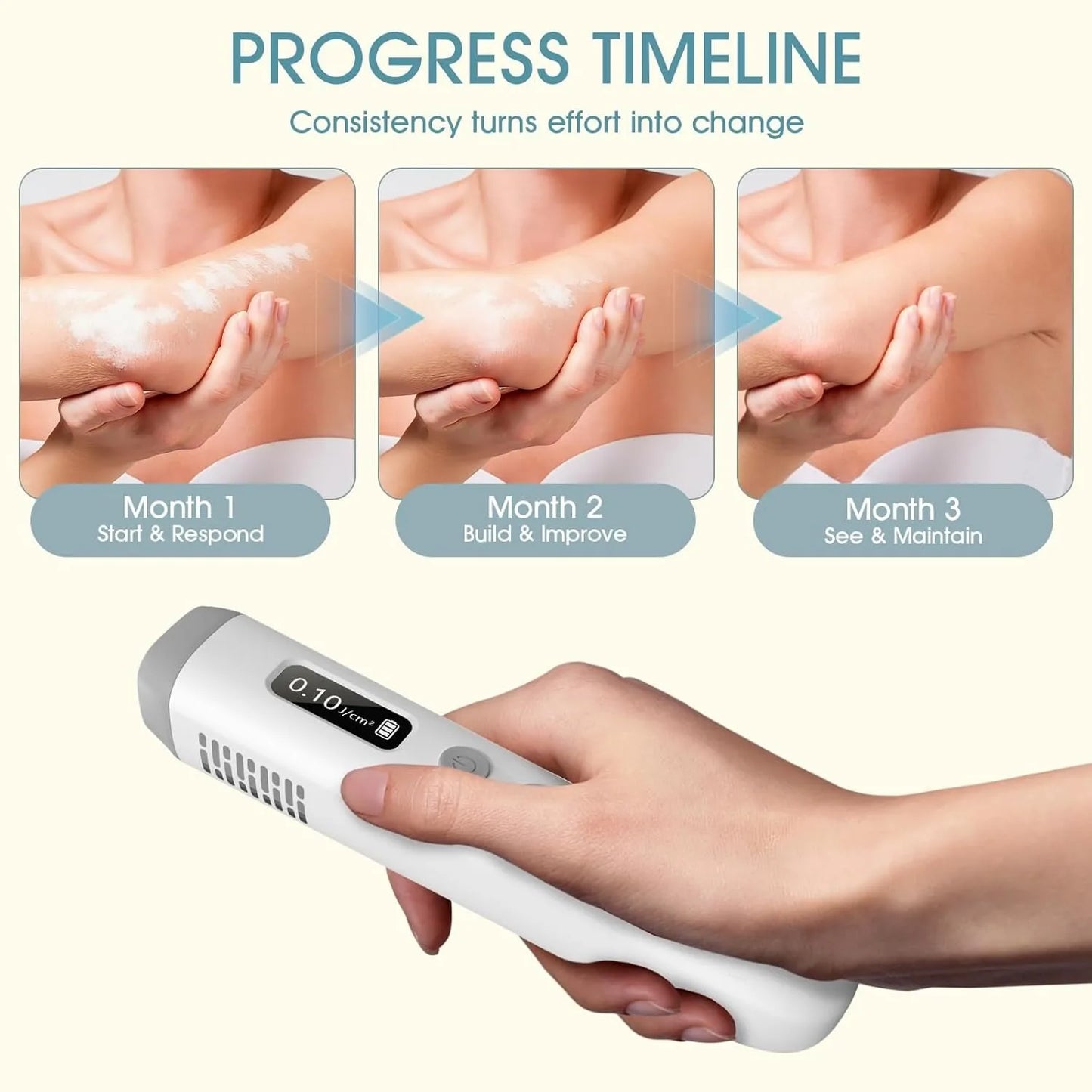 308nm UVB Vitiligo Phototherapy Lamp Handheld Home Use UV Light Therapy Device for Psoriasis Eczema White Spots Skin Treatment